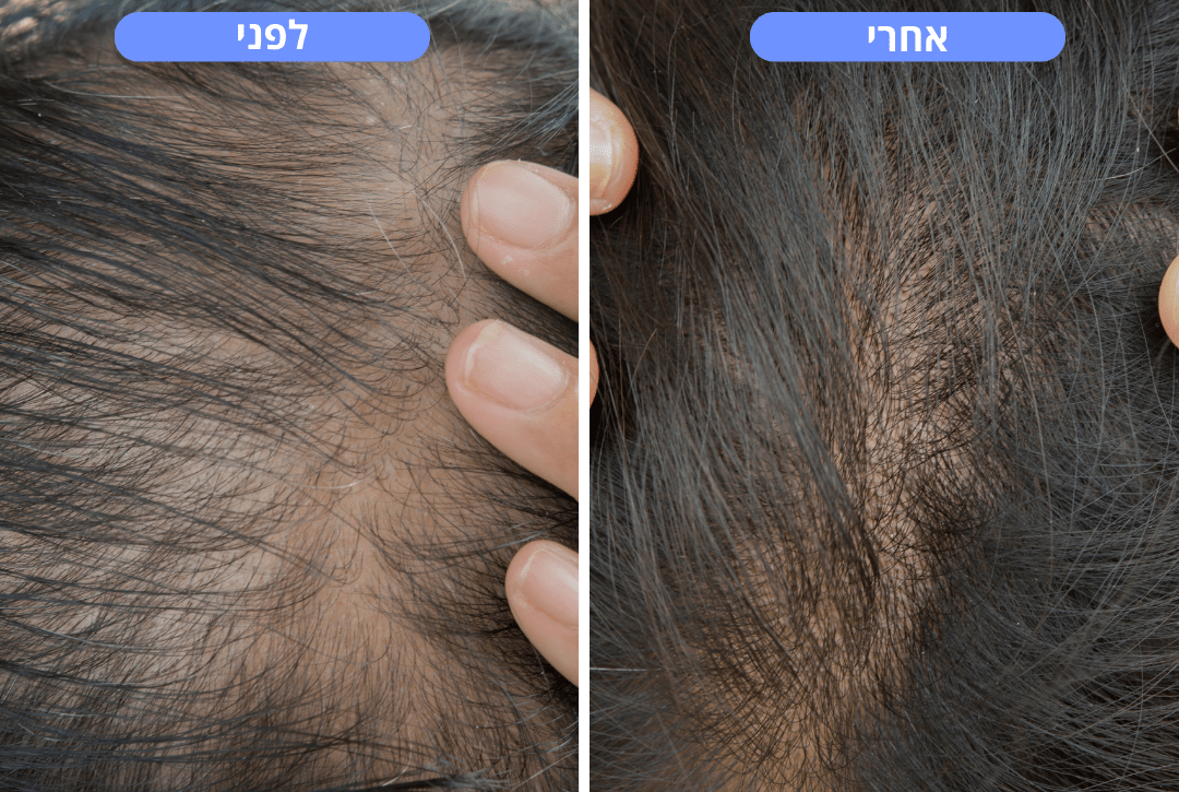 מכשיר חכם לעיסוי הקרקפת | הדרך הטבעית להפחית נשירת שיער - Pomy Sport
