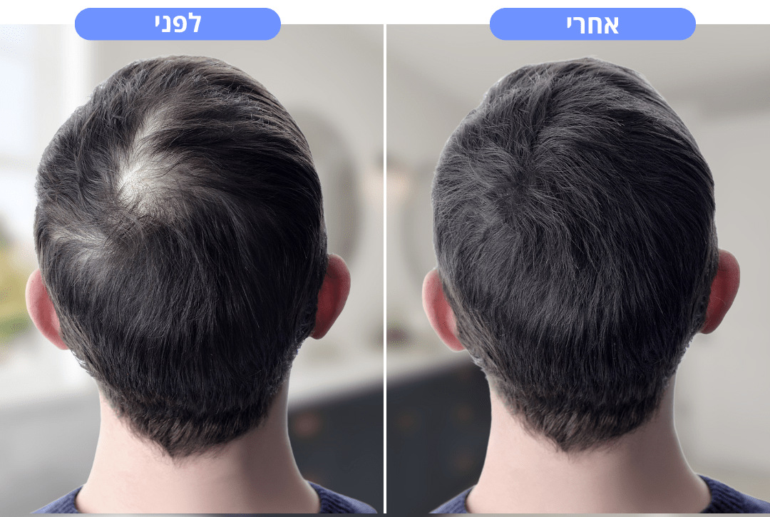 מכשיר חכם לעיסוי הקרקפת | הדרך הטבעית להפחית נשירת שיער - Pomy Sport