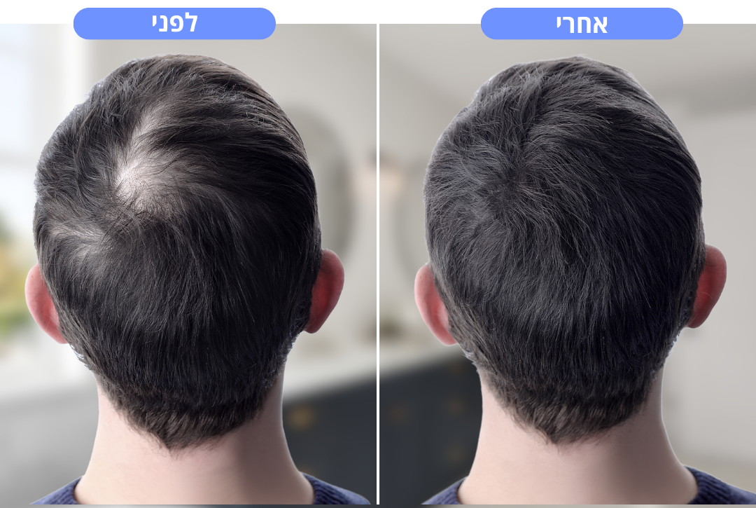 מכשיר חכם לעיסוי הקרקפת | הדרך הטבעית להפחית נשירת שיער