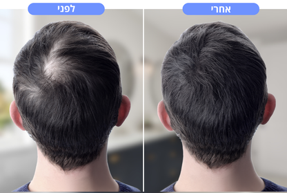 מכשיר חכם לעיסוי הקרקפת | הדרך הטבעית להפחית נשירת שיער